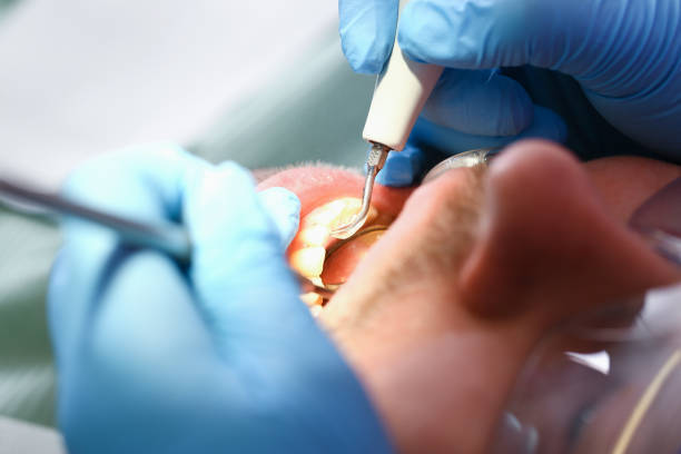 Best Broken or Chipped Tooth Repair in Sebring, OH